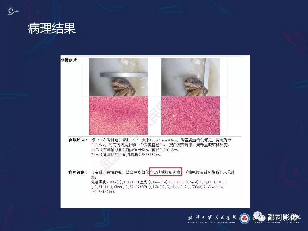 【PPT】常见肾脏肿瘤影像诊断