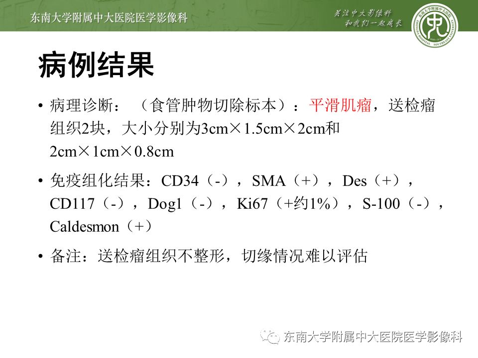 【病例】食管平滑肌瘤1例CT影像