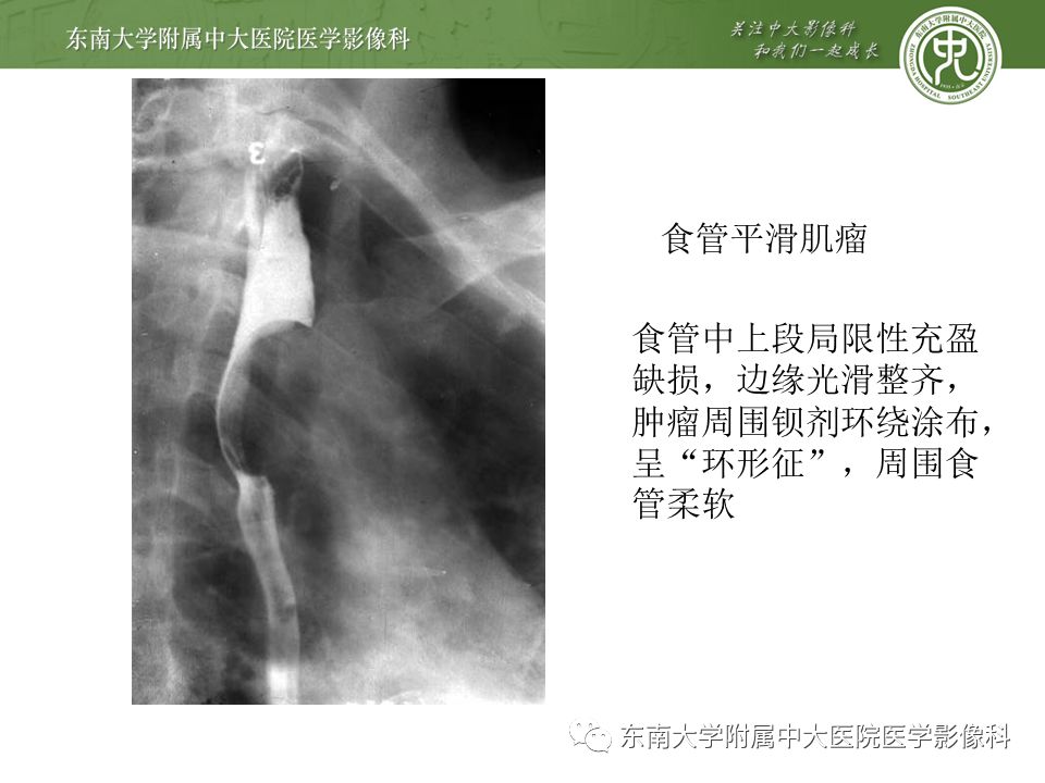 【病例】食管平滑肌瘤1例CT影像