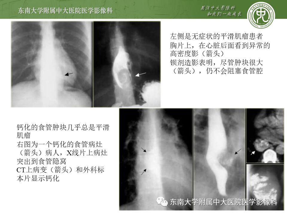 【病例】食管平滑肌瘤1例CT影像