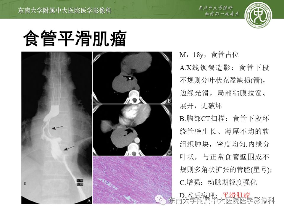 【病例】食管平滑肌瘤1例CT影像