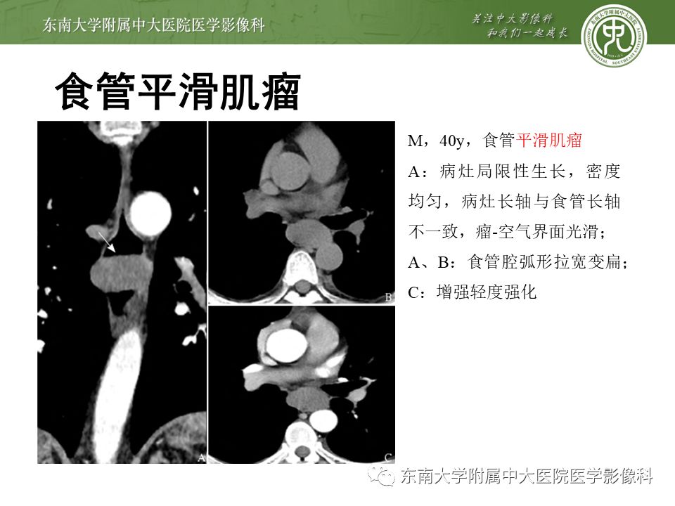 【病例】食管平滑肌瘤1例CT影像