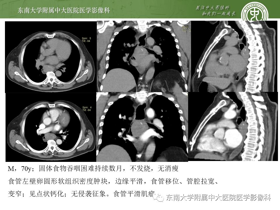 【病例】食管平滑肌瘤1例CT影像