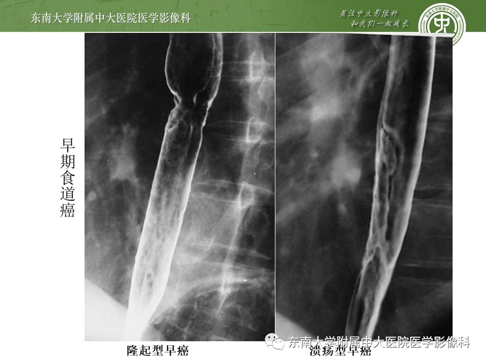 【病例】食管平滑肌瘤1例CT影像