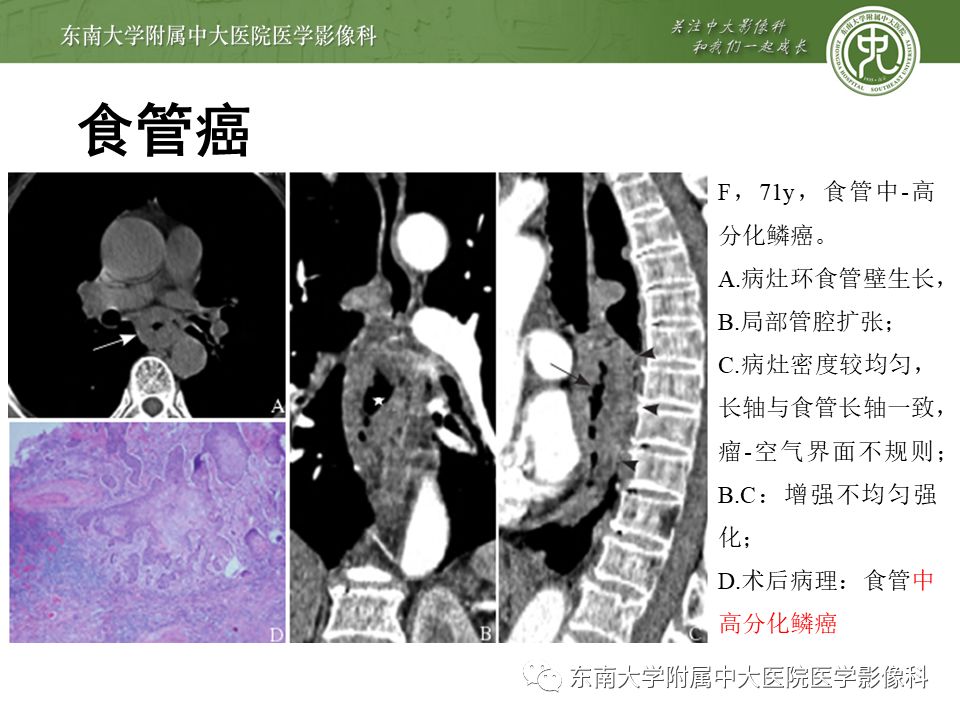 【病例】食管平滑肌瘤1例CT影像