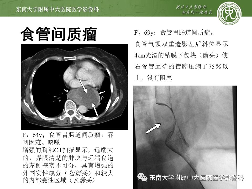 【病例】食管平滑肌瘤1例CT影像