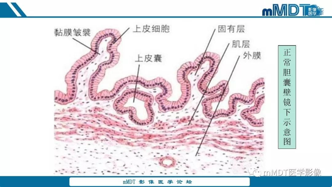 【PPT】胆囊息肉样病变影像诊断
