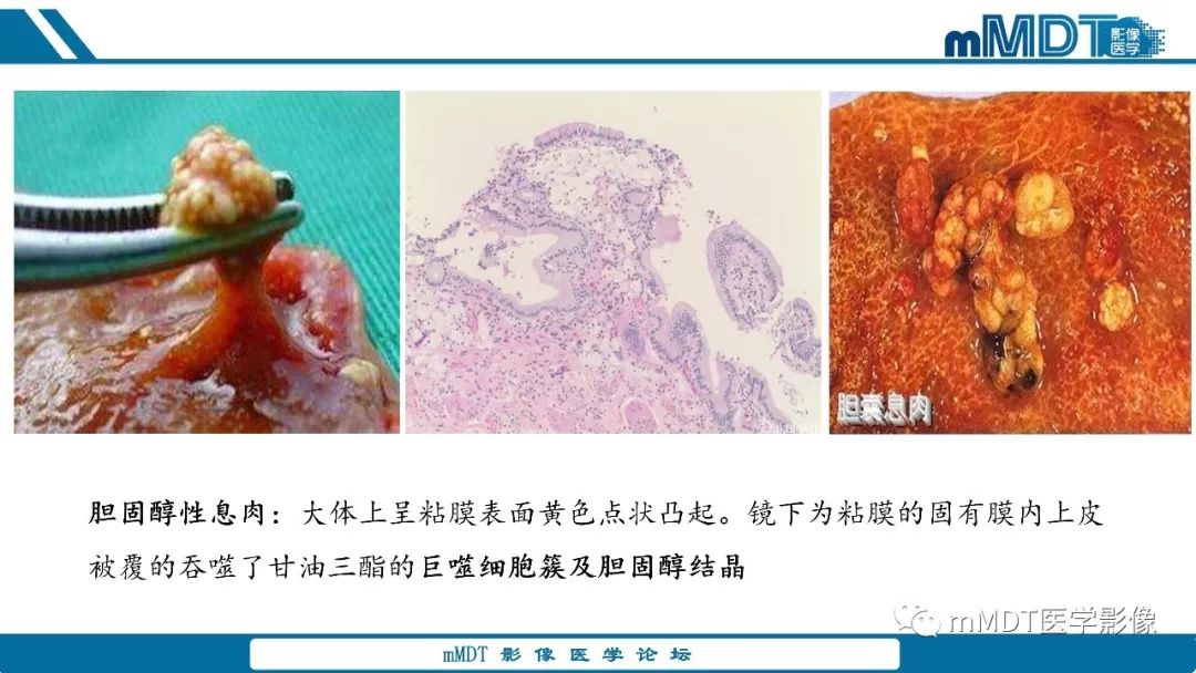 【PPT】胆囊息肉样病变影像诊断