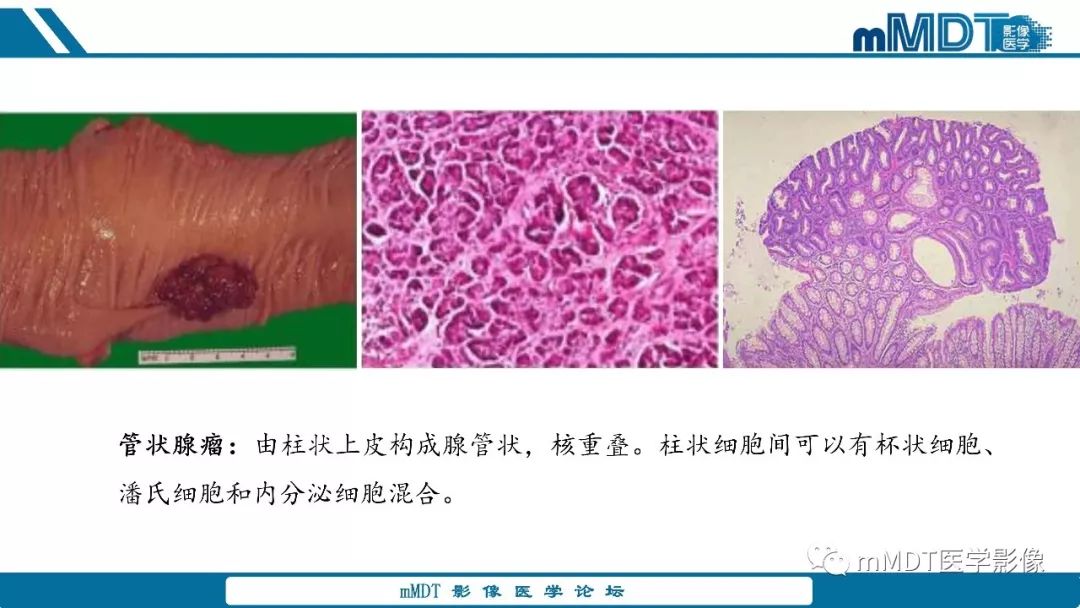 【PPT】胆囊息肉样病变影像诊断
