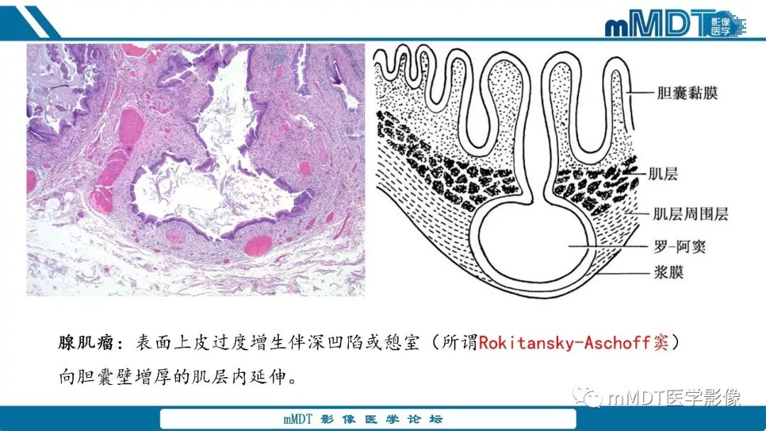【PPT】胆囊息肉样病变影像诊断