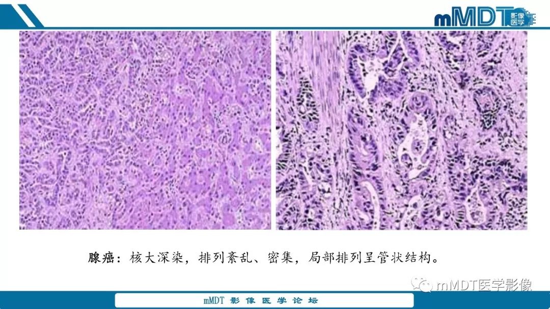 【PPT】胆囊息肉样病变影像诊断