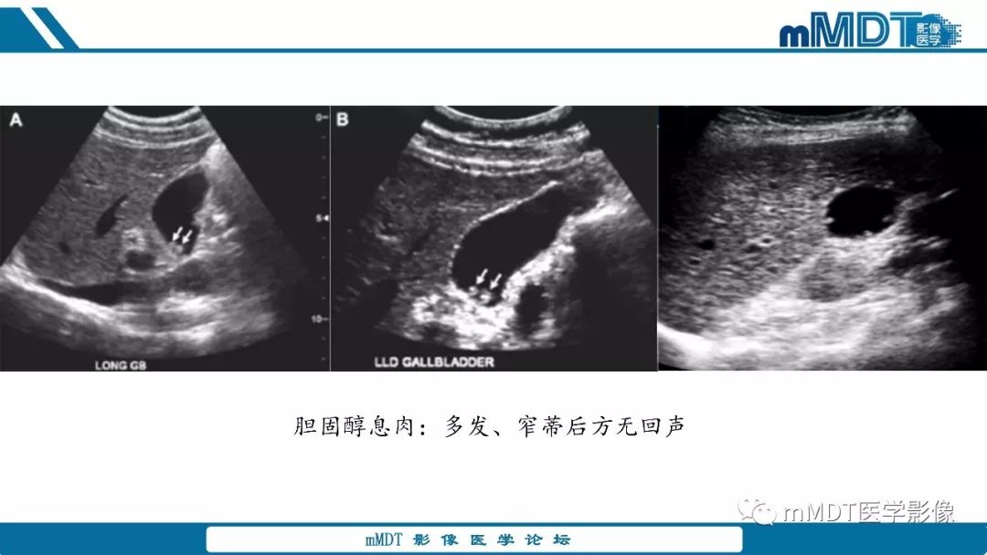 【PPT】胆囊息肉样病变影像诊断