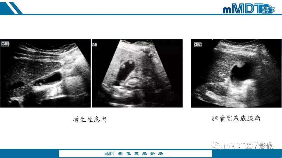 【PPT】胆囊息肉样病变影像诊断