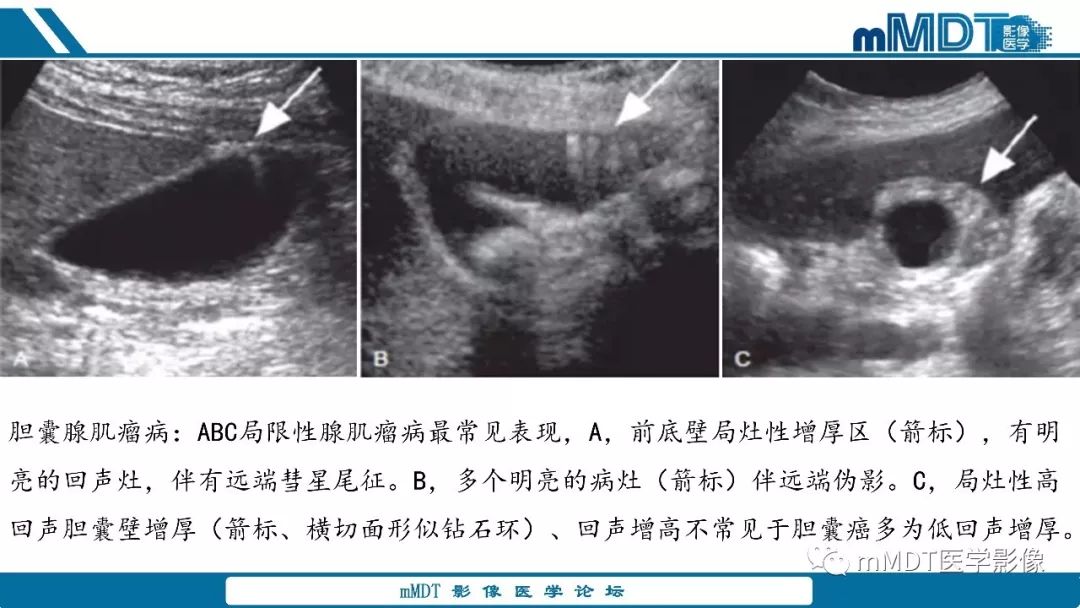 【PPT】胆囊息肉样病变影像诊断