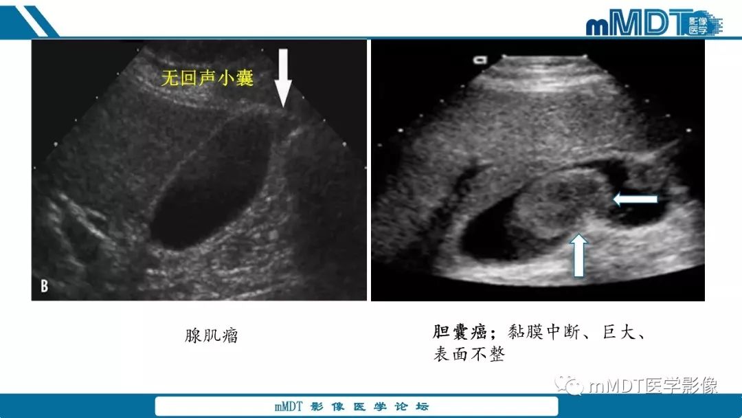 【PPT】胆囊息肉样病变影像诊断