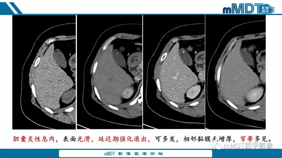 【PPT】胆囊息肉样病变影像诊断