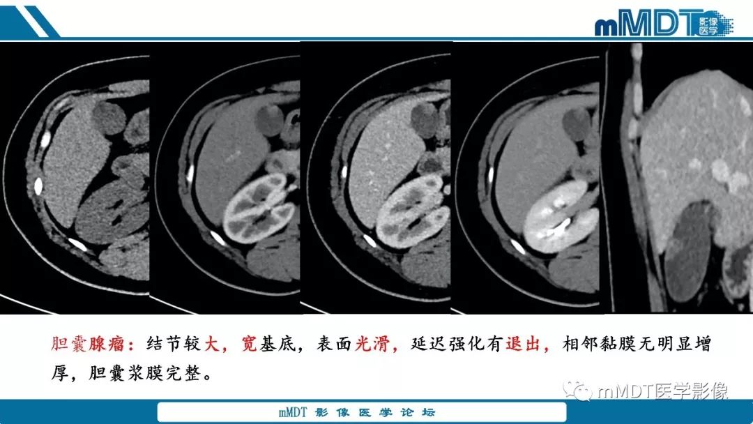 【PPT】胆囊息肉样病变影像诊断