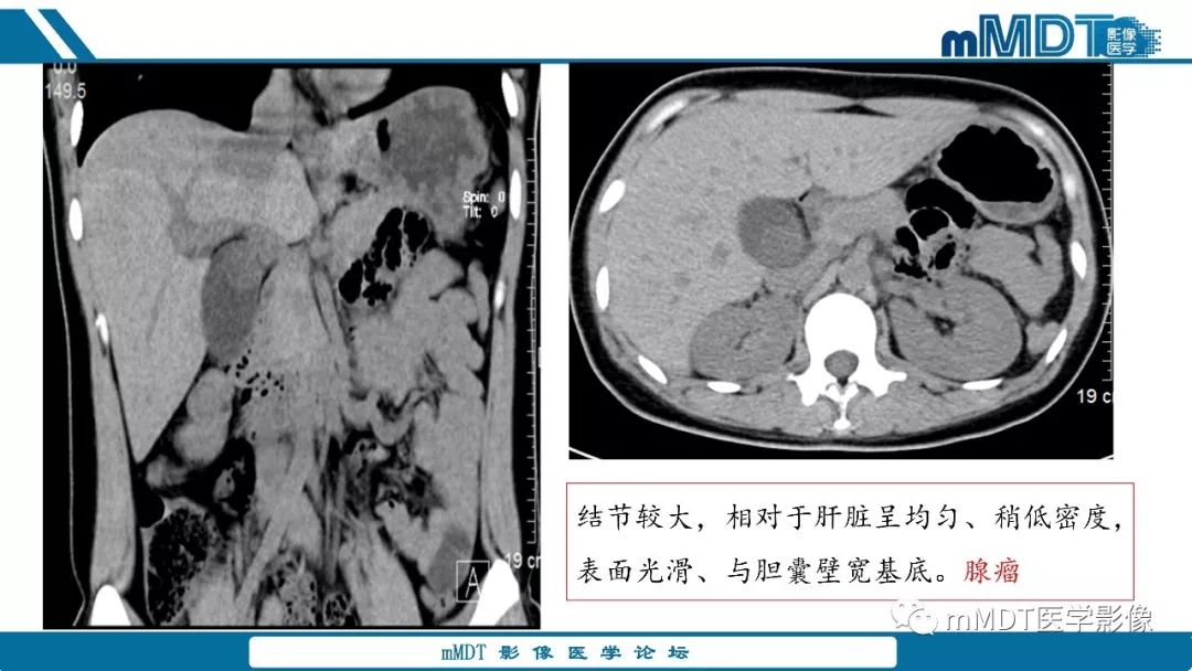 【PPT】胆囊息肉样病变影像诊断