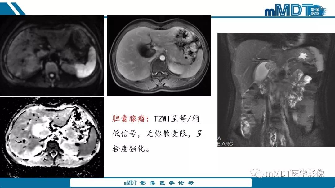 【PPT】胆囊息肉样病变影像诊断