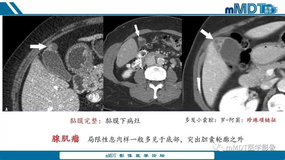 【PPT】胆囊息肉样病变影像诊断