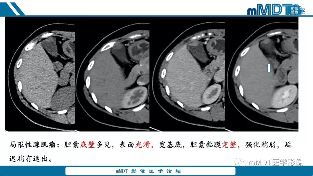 【PPT】胆囊息肉样病变影像诊断