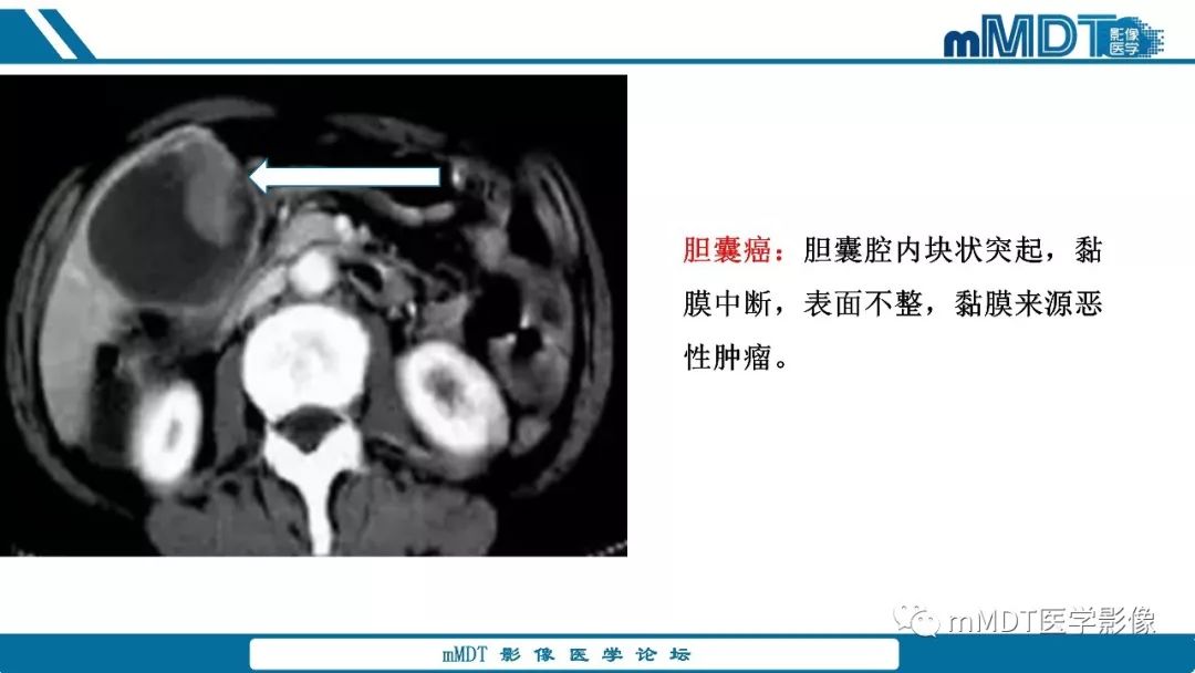 【PPT】胆囊息肉样病变影像诊断