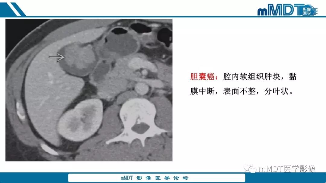 【PPT】胆囊息肉样病变影像诊断