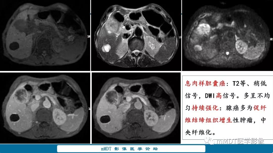 【PPT】胆囊息肉样病变影像诊断