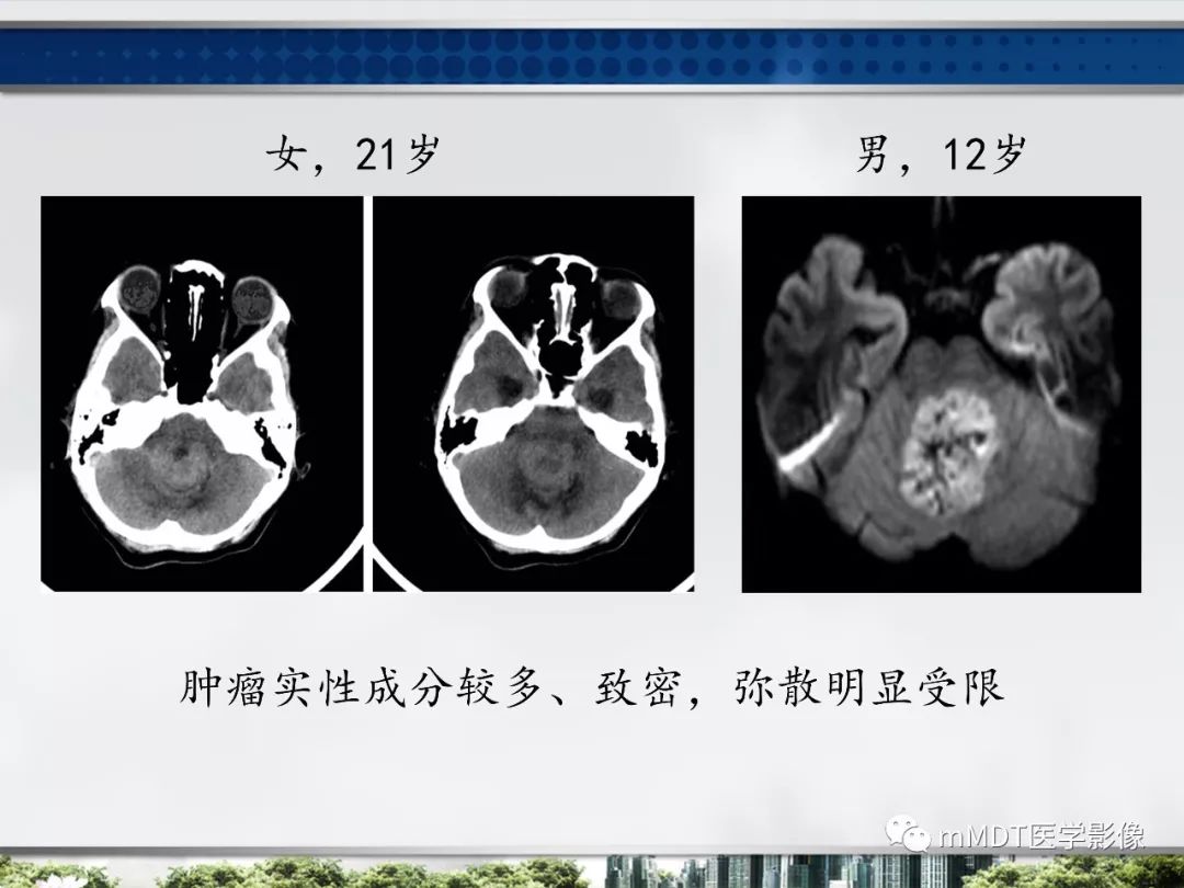 【PPT】四脑室肿瘤影像诊断与鉴别诊断