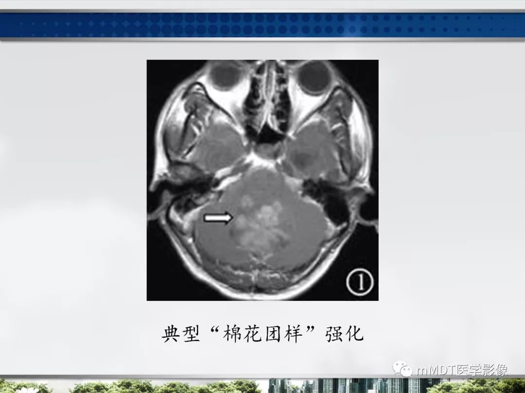 【PPT】四脑室肿瘤影像诊断与鉴别诊断
