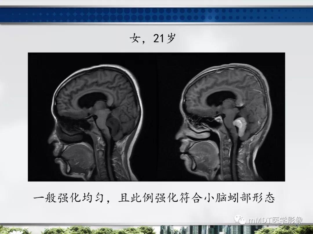 【PPT】四脑室肿瘤影像诊断与鉴别诊断