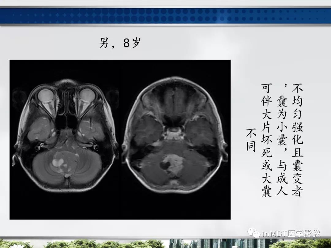 【PPT】四脑室肿瘤影像诊断与鉴别诊断