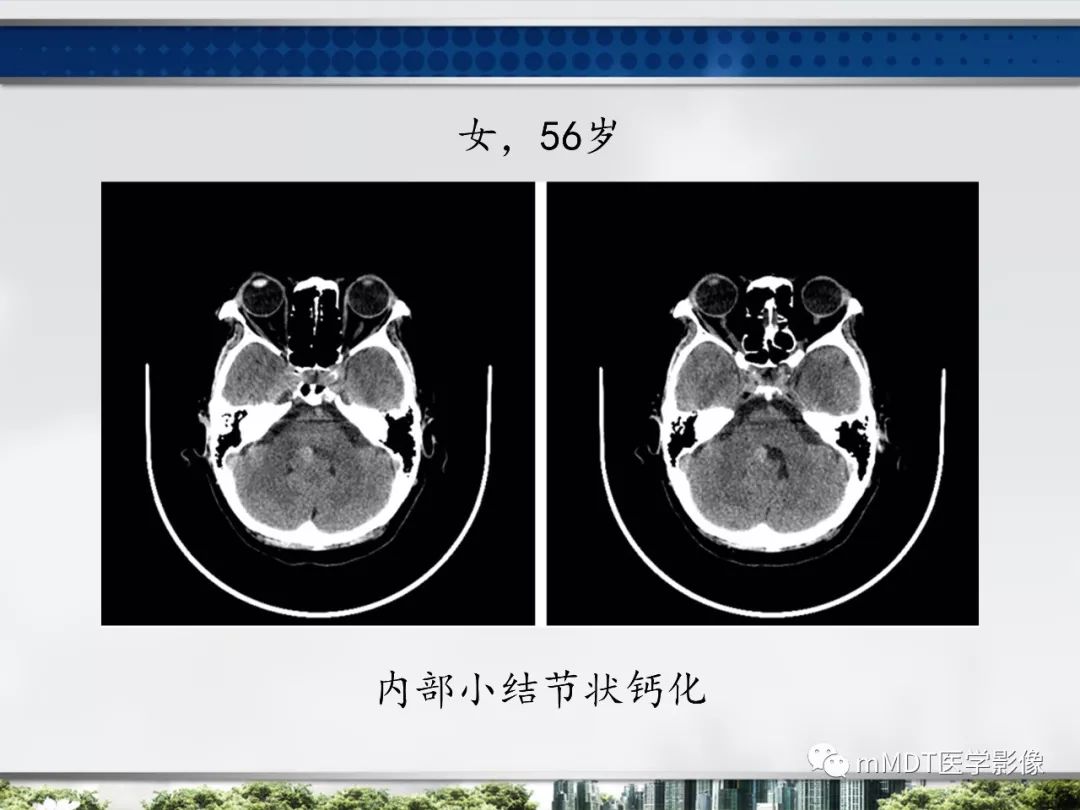 【PPT】四脑室肿瘤影像诊断与鉴别诊断