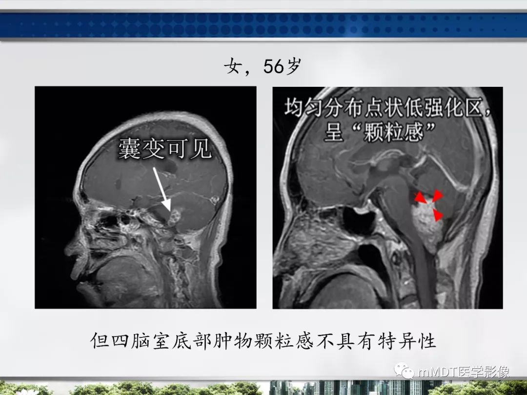 【PPT】四脑室肿瘤影像诊断与鉴别诊断