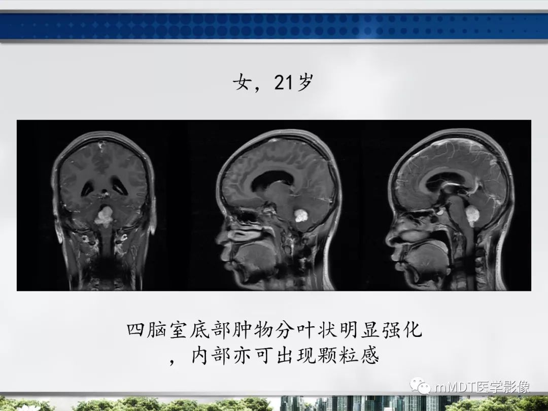 【PPT】四脑室肿瘤影像诊断与鉴别诊断