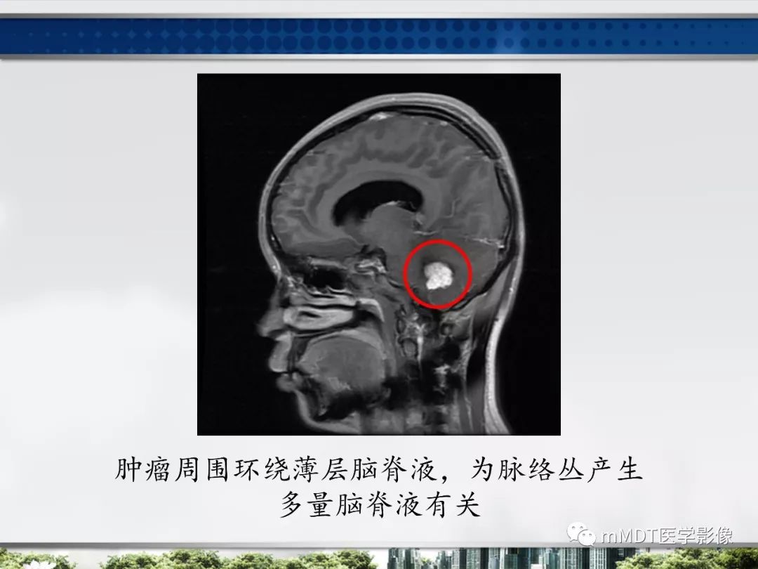 【PPT】四脑室肿瘤影像诊断与鉴别诊断