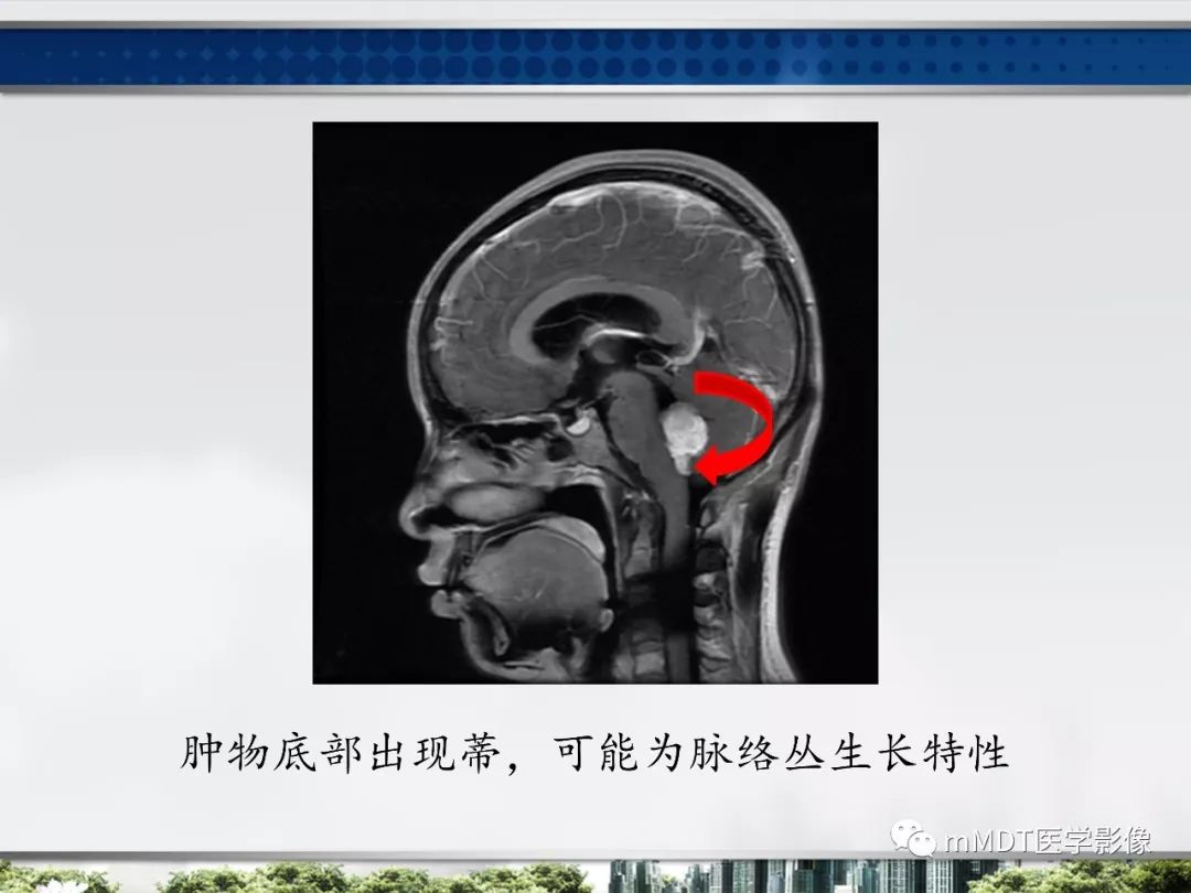 【PPT】四脑室肿瘤影像诊断与鉴别诊断