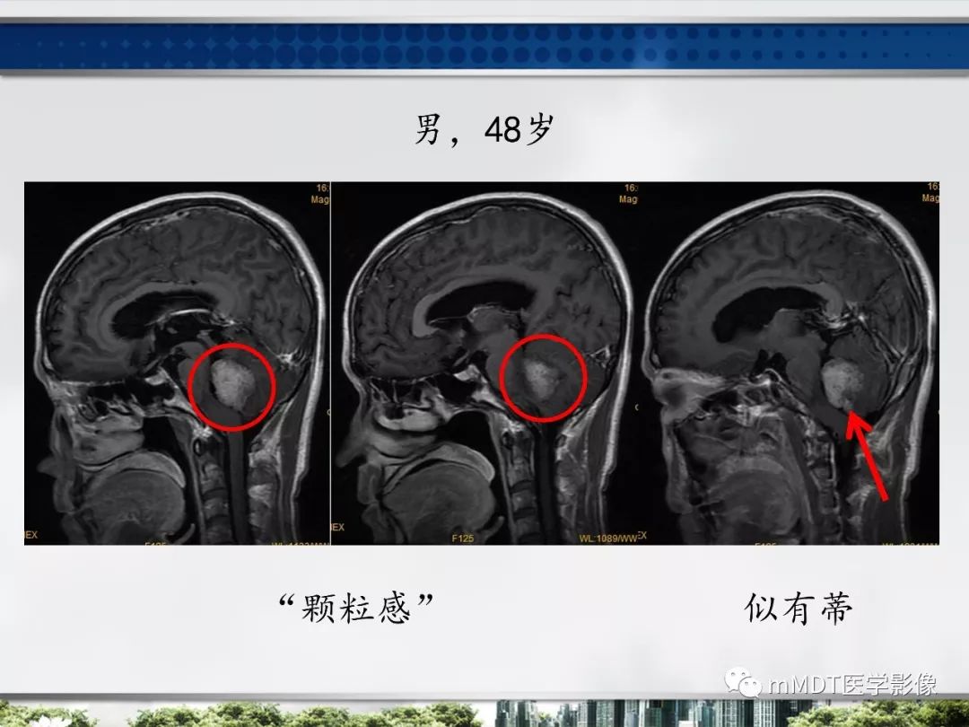 【PPT】四脑室肿瘤影像诊断与鉴别诊断