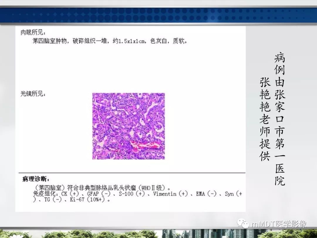 【PPT】四脑室肿瘤影像诊断与鉴别诊断
