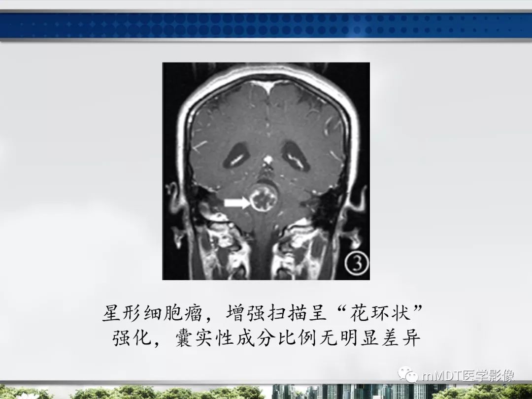 【PPT】四脑室肿瘤影像诊断与鉴别诊断