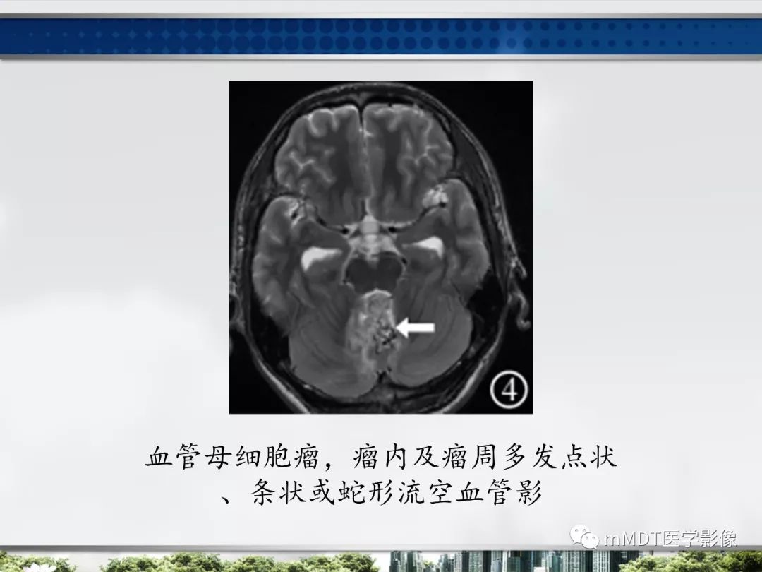 【PPT】四脑室肿瘤影像诊断与鉴别诊断