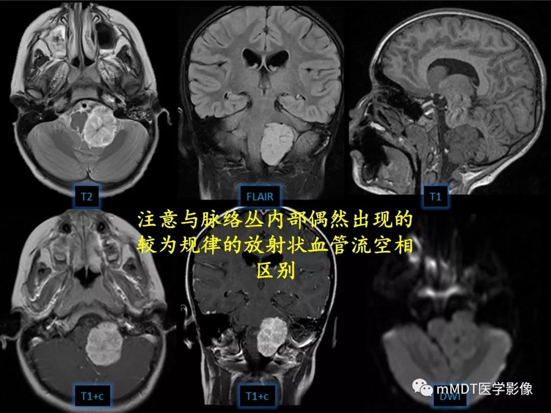 【PPT】四脑室肿瘤影像诊断与鉴别诊断