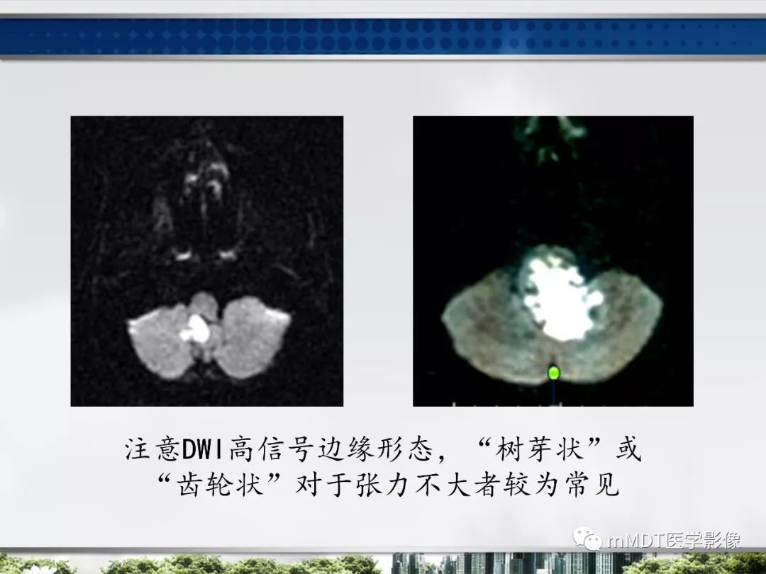 【PPT】四脑室肿瘤影像诊断与鉴别诊断