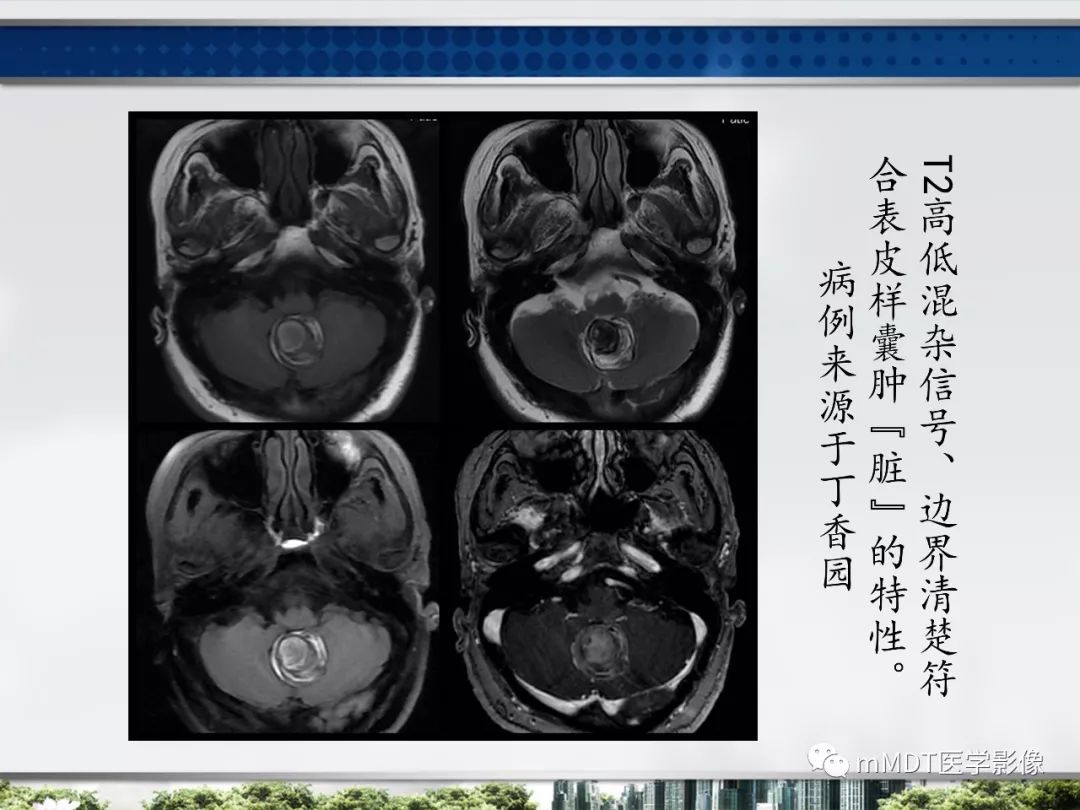 【PPT】四脑室肿瘤影像诊断与鉴别诊断