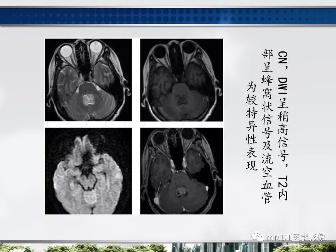【PPT】四脑室肿瘤影像诊断与鉴别诊断