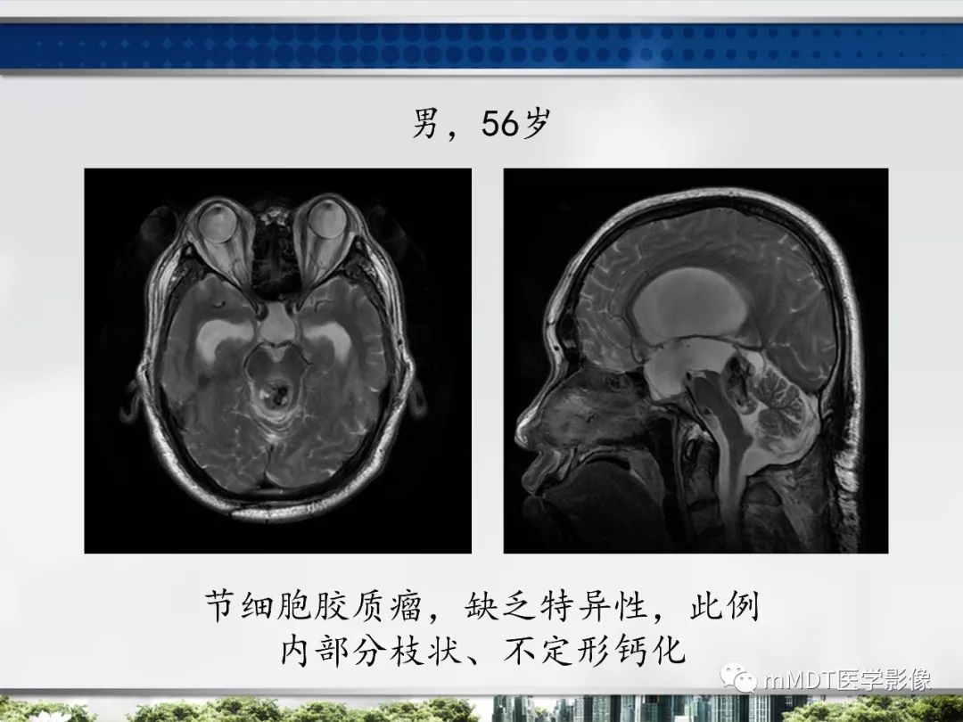 【PPT】四脑室肿瘤影像诊断与鉴别诊断