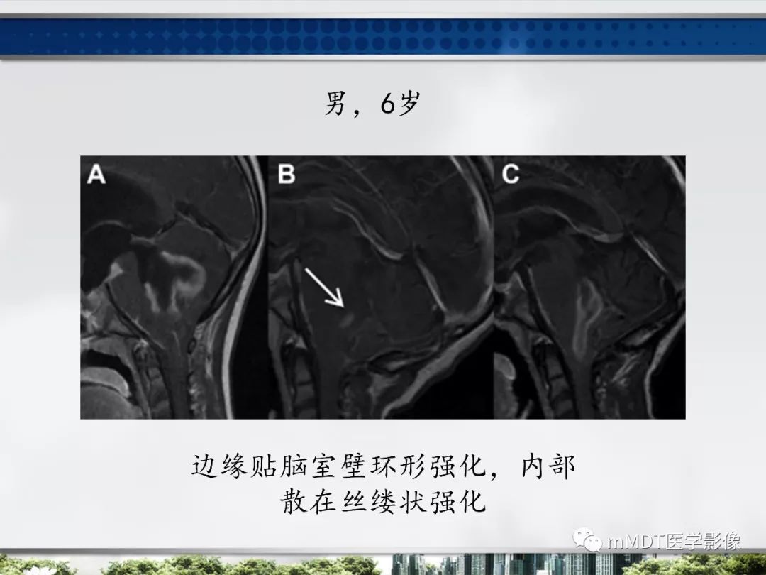 【PPT】四脑室肿瘤影像诊断与鉴别诊断