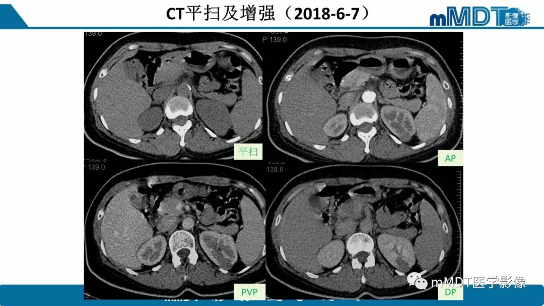 【病例】肾脏嫌色细胞癌1例CT及MR