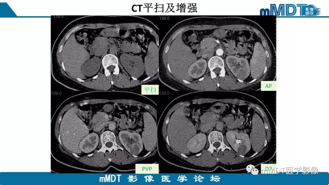 【病例】肾脏嫌色细胞癌1例CT及MR