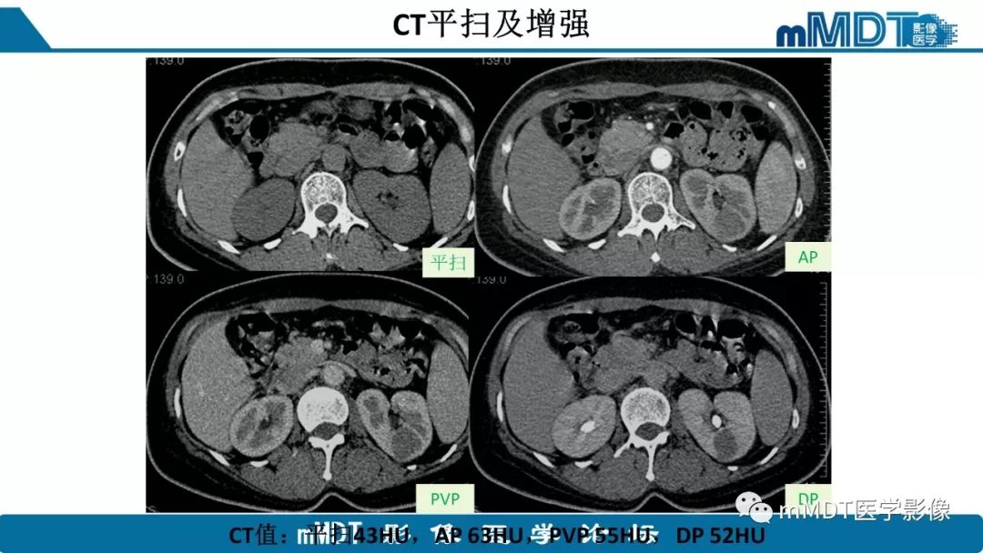 【病例】肾脏嫌色细胞癌1例CT及MR